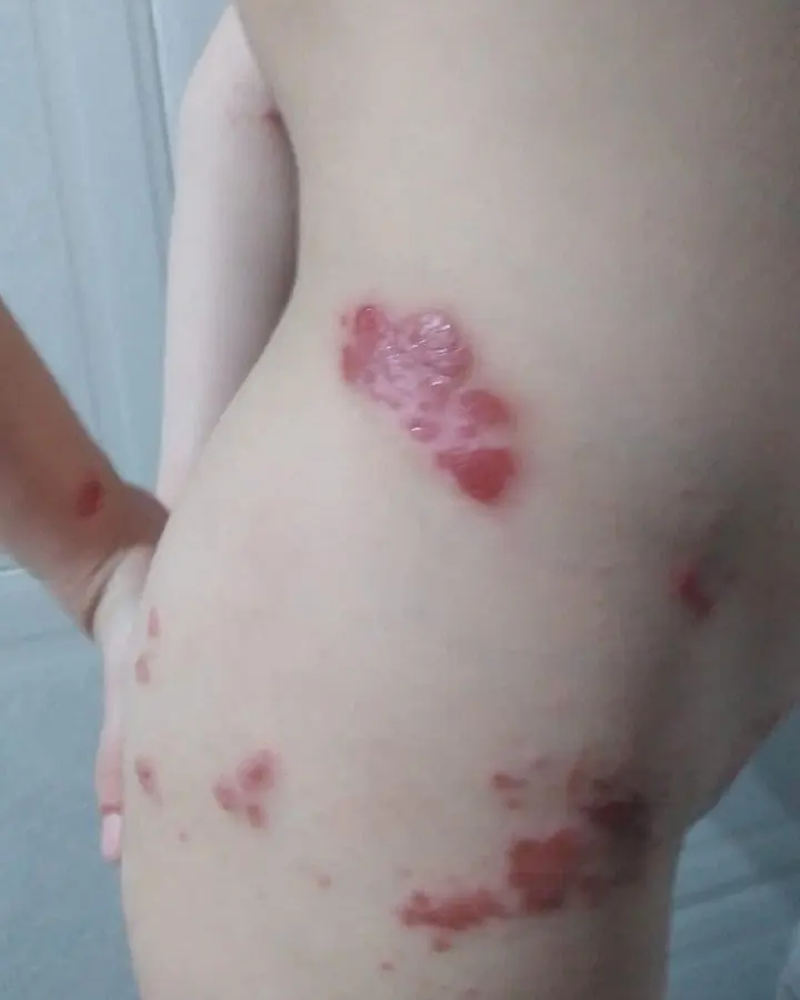 Piel atópica severa